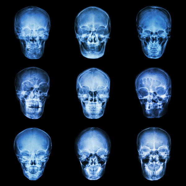 人脑X光片图片