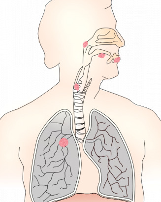 肺癌的矢量图像符号
