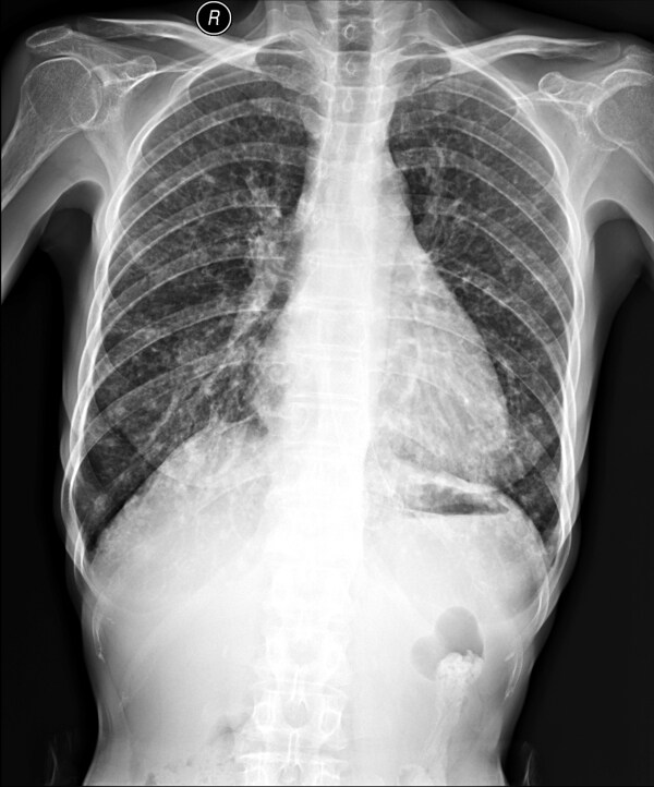 X线胸部拍片