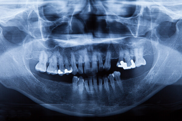 牙齿X光片图片