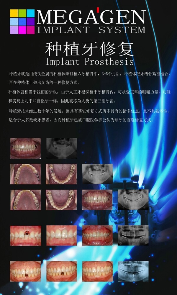 口腔种植牙修复图片